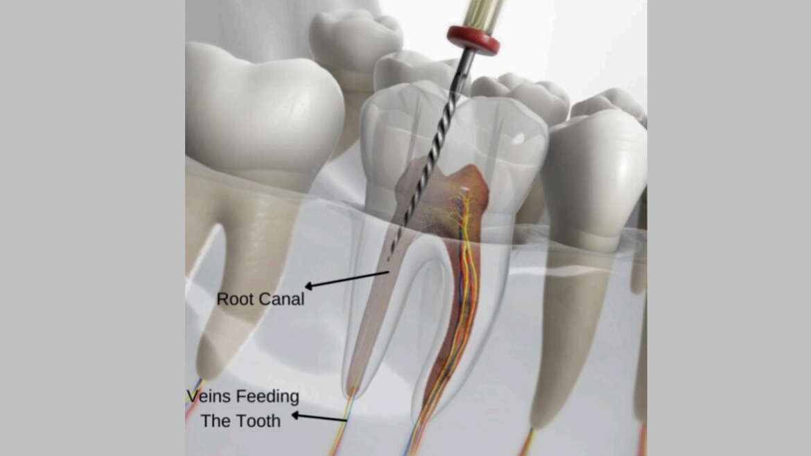 Root Canal Treatment