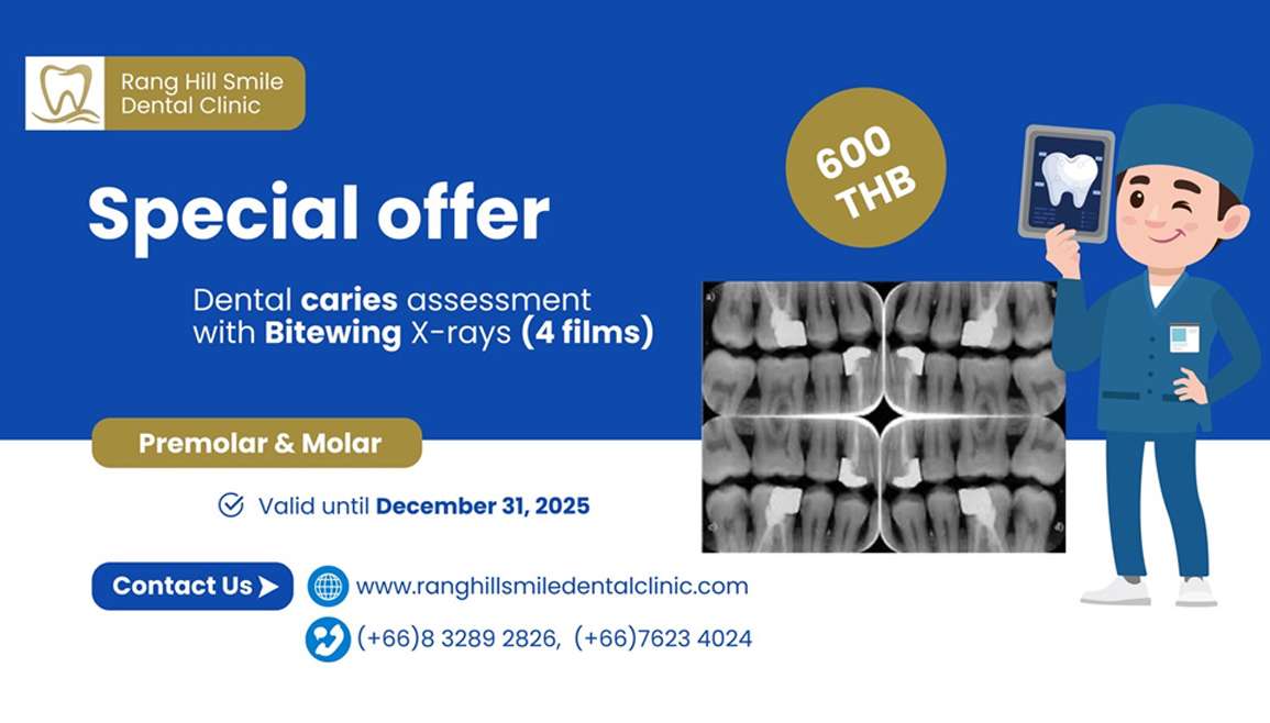 Dental caries assessment with Bitewing X-Rays