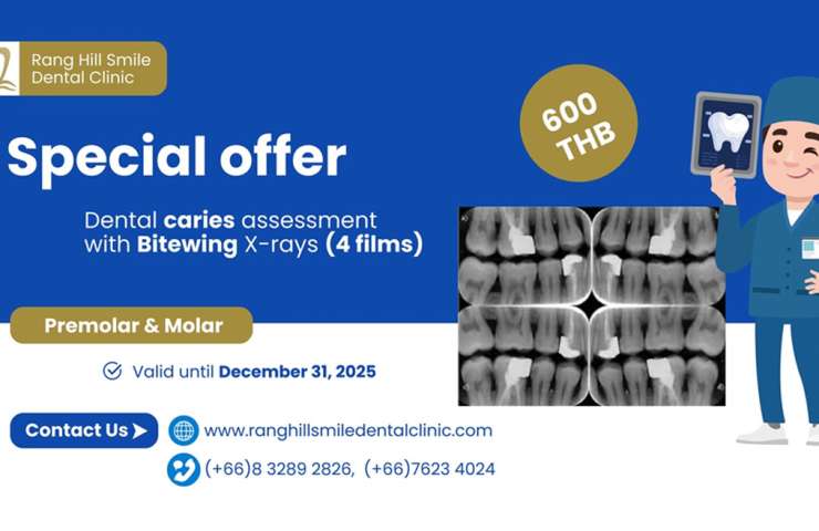 Dental caries assessment with Bitewing X-Rays