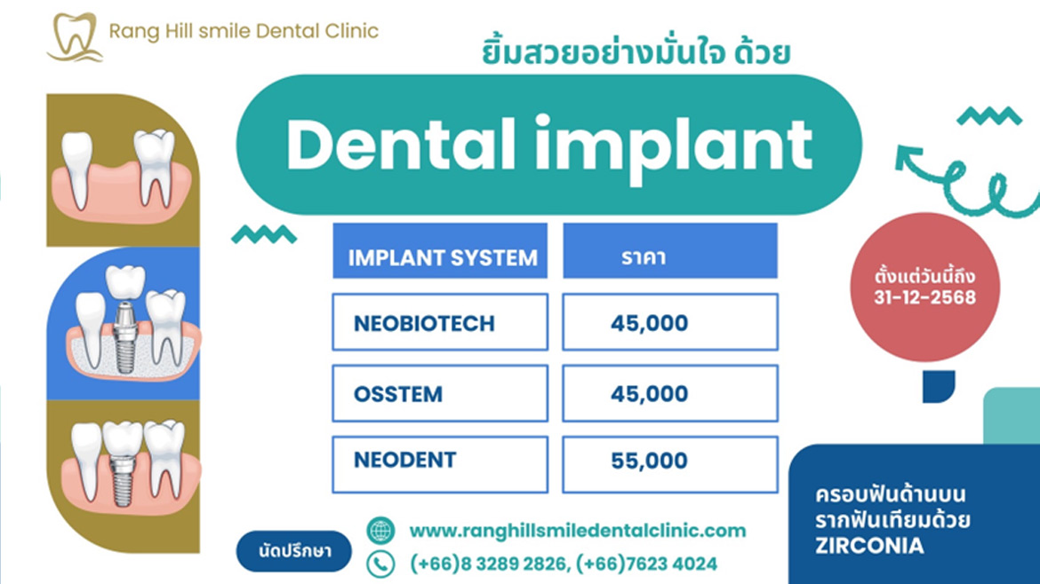 ยิ้มสวยอย่างมั่นใจด้วย Dental implant